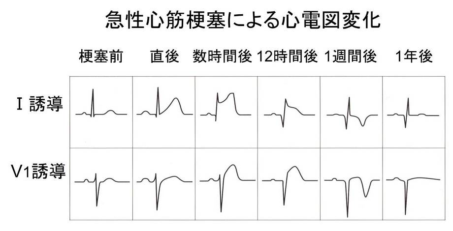 虚血性心疾患の心電図診断と治療 小菅雅美先生 | 川村内科診療所様