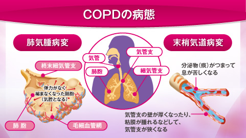 ｃｏｐｄの併存症とその対策及び最新治療 桑平一郎教授 川村内科診療所様