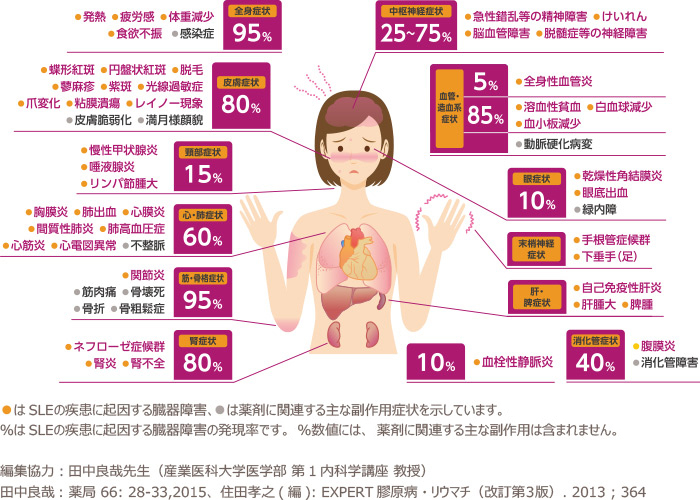 全身性エリテマトーデスの写真